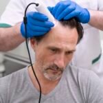 Causes et solutions perte de cheveux, Perte de cheveux