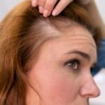 Causes et solutions perte de cheveux, Perte de cheveux
